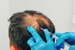 PRP Haare Haartransplantation - Wien